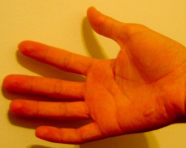 Łuszczyca – jak radzić sobie z uporczywym swędzeniem?